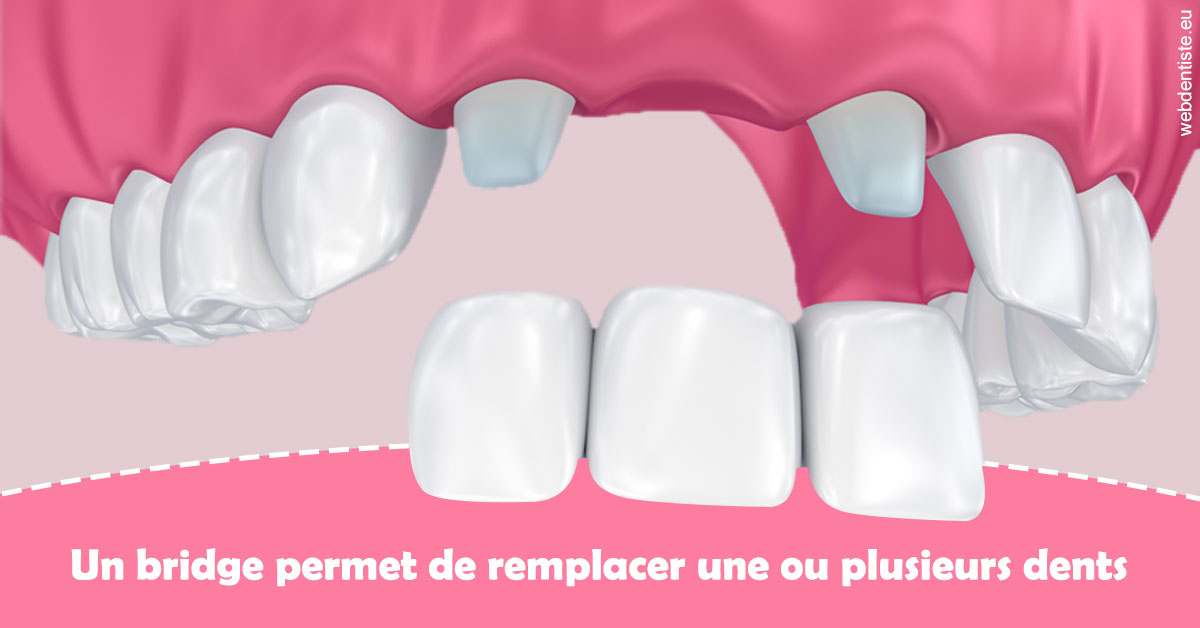https://dr-bourlon-jean-pierre.chirurgiens-dentistes.fr/Bridge remplacer dents 2