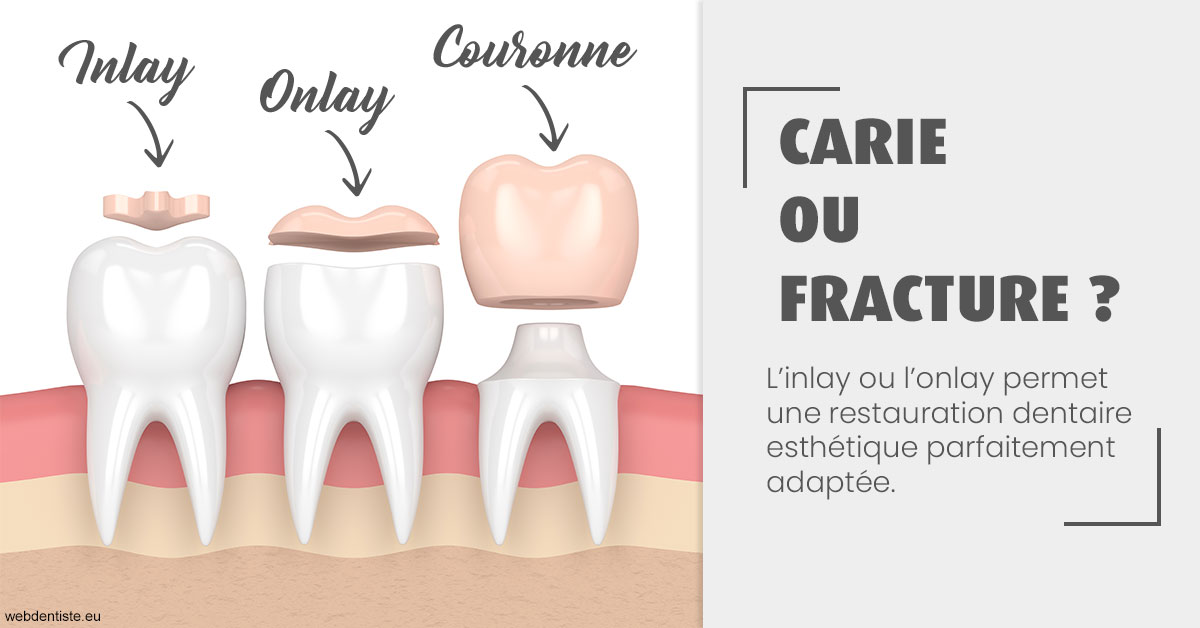 https://dr-bourlon-jean-pierre.chirurgiens-dentistes.fr/T2 2023 - Carie ou fracture 1