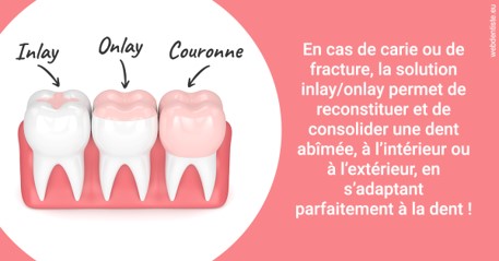 https://dr-bourlon-jean-pierre.chirurgiens-dentistes.fr/L'INLAY ou l'ONLAY 2