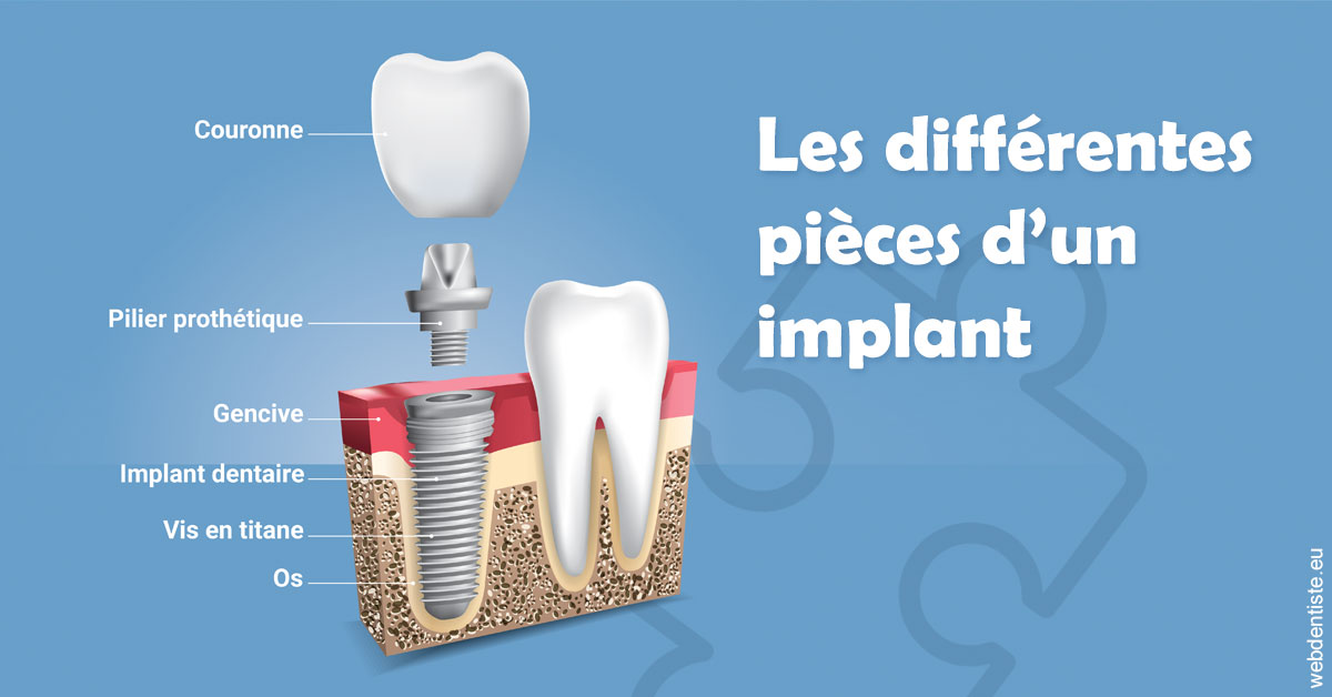 https://dr-bourlon-jean-pierre.chirurgiens-dentistes.fr/Les différentes pièces d’un implant 1